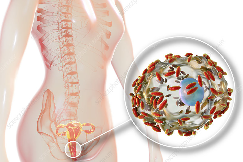 bacterial-vaginosis